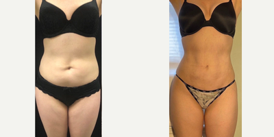 25-34 year old woman treated with Liposuction - 2 months s/p SAFE LIPO