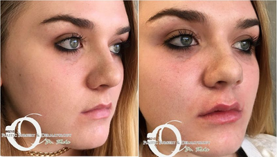 Woman treated with Lip Augmentation - Woman treated with Lip Augmentation