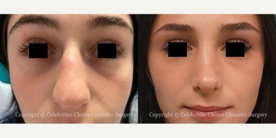 18-24 year old woman treated with Rhinoplasty - This patient had Reduction Rhinoplasty through a closed technique