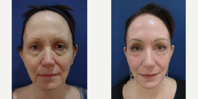 55-64 year old woman treated with Skin Tightening - 60 year old female 3 months status post cool helium plasma resurfacing and one week following lower blepharoplasty (lower eyelid surgery). Patient is estatic with her new smooth complexion younger looking face.