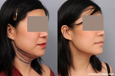 40 year old woman treated with Radiesse - 40 year old woman treated with Radiesse in the upper cheeks