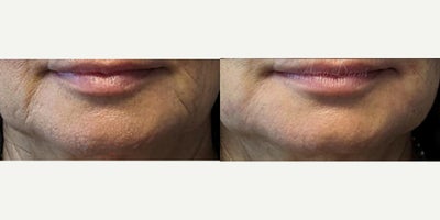 55-64 year old woman treated with Juvederm, Vollure - Treatment of marionette lines with Juvederm, Radiesse, Vollure, Restylane or Bellafill injected with cannula