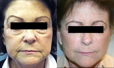 Ultherapy -
Full face Ultherapy treatment