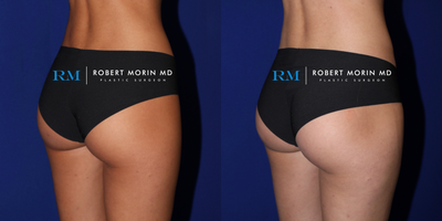 18-24 year old woman treated with Emsculpt - This 21 year old female underwent 6 Emsculpt treatments in order to sculpt and augment her buttocks.