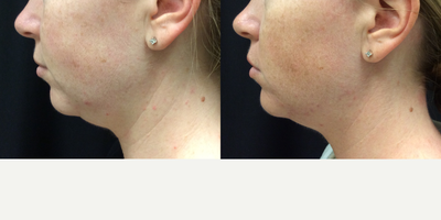 25-34 year old woman treated with CoolMini - Client concerned about the fat in the chin area and wanted more shape to the chin area. Was not interested in any injections or surgery. She had coolsculpting sone and excellent results after chin treatment. Significant fat loss and more definition to the chin.