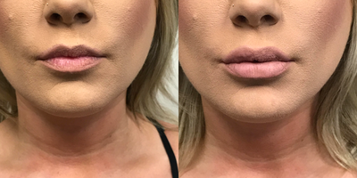 25-34 year old woman treated with Juvederm - Shown before and immediately after one syringe Juvederm to upper and lower lips.