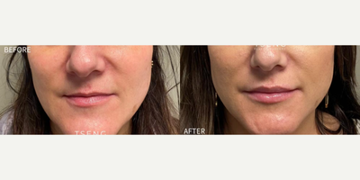 Woman treated with Dermal Fillers, Cheek Fillers, Lip Fillers - Fillers in Cheeks and Lips