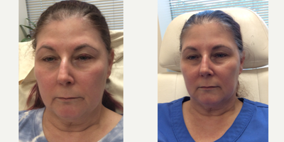 55-64 year old woman treated with Radiesse Dermal Filler to the Cheeks, Chin, Jawline - Patient wanted to enhance her natural features while also addressing volume loss. Radiesse filler was injected to the Cheeks, Chin and Jawline.