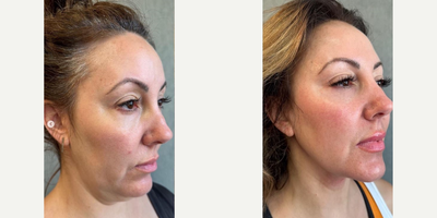 Woman treated with Chin Liposuction - Woman treated with Chin Liposuction.
