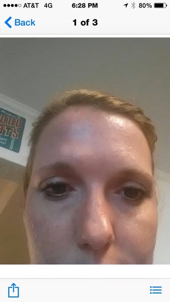 facial swelling tenderness after bridgework asian investment bank