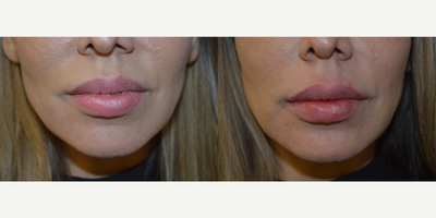 35-44 year old woman treated with Lip Augmentation - 44 year old female lip augmentation with Restylane Kysse to give subtle volume enhancement and improved contour of lips. After photo is immediately following treatment.