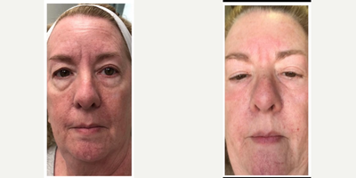 55-64 year old woman treated with Plasma Pen - 55-64 year old woman treated with Plasma Pen in the upper and lower eye lids, and glabella region.