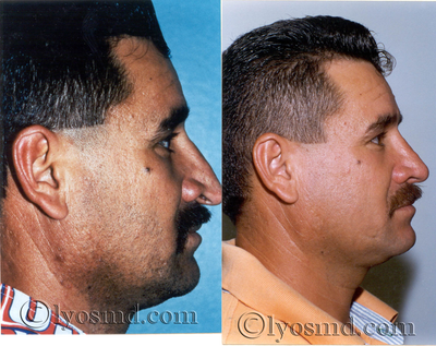 Rhinoplasty, Septoplasty -
39-year-old gentleman before and after rhinoplasty and correction of breathing problems.