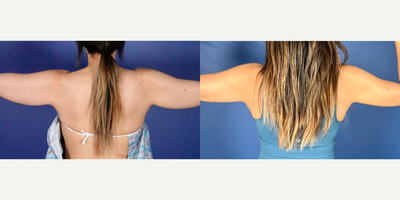 35-44 year old woman treated with BodyTite - PROCEDURE DETAILSBodyTite with Liposuction of ArmsPost-operative photo taken at 8 monthsPATIENT INFOSex: FemaleAge: 39
