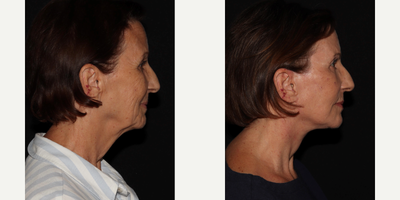 55-64 year old woman treated with Facelift, Eyelid Surgery, Laser Resurfacing, Facial Fat Transfer - MD Restore, Deep-Plane (Additional Procedures: Eyelids, Laser Resurfacing, Fat Transfer)