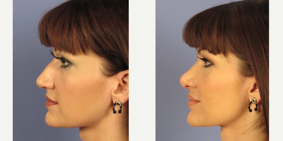 25-34 year old woman treated with Rhinoplasty - Here is a woman at her 2 months appointment after rhinoplasty surgery. The tip is still slightly swollen and this will improve over the next few months.