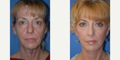55-64 year old woman treated with Facelift - Nice improvement in jawline and neck with lower face and necklift.