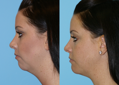 Chin Implant -
This patient had a mersiline mesh implant to project her chin. This has now put the rest of her face in balance.