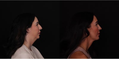 35-44 year old woman treated with Neck Lift, Chin Implant, Facial Fat Transfer, Rhinoplasty - Beautiful results for our patient now 3 months after deep neck lift, chin implant, facial fat grafting, and subtle rhinoplasty! We rebalanced her by contouring the deep neck structures and glands and adding volume to her temples, along the jawline, near her chin, and elsewhere. We also added a chin implant to extend her jawline. She is healing so well and has been a gem! Thanks to her for letting us share and continuing to be patient with the healing process!