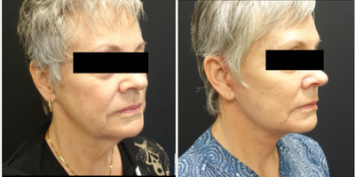 55-64 year old woman treated with Face and Neck lift with facial fat grafting. - Patient underwent a high lateral SMAS face and neck lift with platysma band plication and facial fat grafting. The combination of all these techniques give her a dramatic difference in her neck while still maintaining a natural appearance to the face overall. The fat grafting restores the volume that patients lose over time as they age. The combination of the fat transfer and facelift give patients a more natural and youthful appearance.