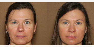 Woman treated with Brow Lift - Woman treated with Brow Lift