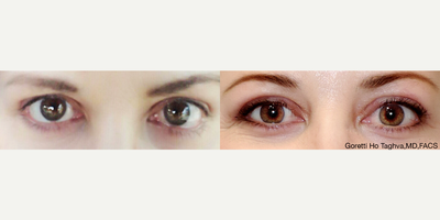 35-44 year old woman treated with Upper Eyelid Surgery - Caucasian female complained of tired appearance and excess skin on upper eyelids, s/p upper blepharoplasty