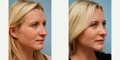 25-34 year old woman treated with Rhinoplasty - Open rhinoplasty with lip filler