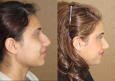 Rhinoplasty / nose job only 2 weeks after procedure -
This is to show that even after only 2 weeks after rhinoplasty/ nose surgery you can look better and breathe better.