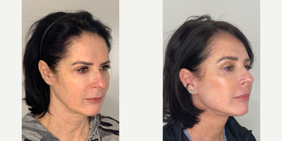 55-64 year old woman treated with Facelift, Neck Lift, Eyelid Surgery, Facial Fat Transfer, CO2 Laser - 58 year old patient 3 months after Facelift, Neck lift, Upper Eyelid Blepharoplasty, Fat Transfer and CO2 laser.