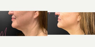 35-44 year old woman treated with Facial, Morpheus8, Microneedling RF - Series of 3 with Alyssa G.