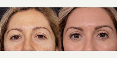 Woman treated with Brow Lift - Woman treated with Brow Lift