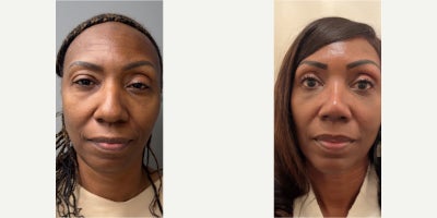 35-44 year old woman treated with Ethnic Rhinoplasty and Chin Implant - Ethnic rhinoplasty was performed on this patient to remove the dorsal hump and improve the overall appearance of her nose. A chin implant was also performed to address her recessed chin and improve facial balancing.