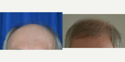 55-64 year old man treated with Artas Robotic Hair Transplant - ARTAS robotic treatment for hair loss in New Orleans, Louisiana