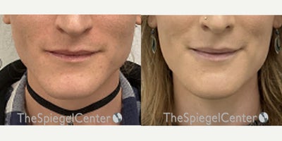 25-34 year old transgender woman treated with Jaw Surgery - 25-34 year old transgender woman treated with Jaw Surgery
