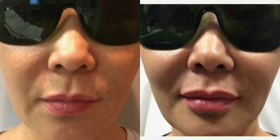 45-54 year old woman treated with Lip Augmentation - Before and after lip with Refyne dermal filler and cheek lift with PDO threads