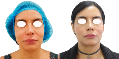 35-44 year old woman treated with Ultherapy - This is a treatment with microfocused ultrasound technology and visualization. Helps achieve a fresher, more youthful look from the eyebrows to the cleavage. Improves skin appearance. Generates skin retraction. Optimize collagen production. Improves tone and texture. Oxygenates and provides hydration to the treated areas.