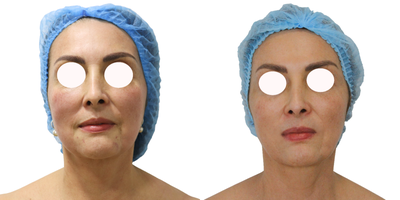 45-54 year old woman treated with Ultherapy - This is a treatment with microfocused ultrasound technology and visualization. Helps achieve a fresher, more youthful look from the eyebrows to the cleavage. Improves skin appearance. Generates skin retraction. Optimize collagen production. Improves tone and texture. Oxygenates and provides hydration to the treated areas.
