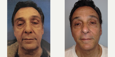 55-64 year old man treated with Facelift and Neck Lift - This patient came to see me looking for a fresh start. He is a single father, who raised his beautiful children on his own. Now that they are older, he wanted to focus on himself and recapture a refreshed, youthful, healthy, and vibrant look to match how he felt on the inside. He did not want to undergo general anesthesia. After spending time to understand his goals, his story, and his aging pattern, I created a treatment plan which centered around a facelift and neck lift (platysmaplasty) to help restore a smoother, contoured jawline and neckline. The procedures were performed under local anesthesia with light oral sedation. His postop photo is 1 year after his surgery.