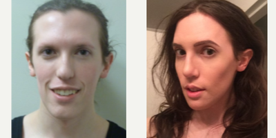 25-34 year old woman treated with Facial Feminization Surgery - 25-34 year old woman treated with Facial Feminization Surgery