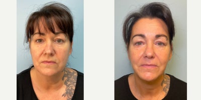 53 year old woman treated with Neck Lift, Renuvion, Liposuction - This case features a 53-year-old female who sought to rejuvenate her appearance with a neck lift. The before image displays noticeable sagging and laxity in the neck area, common concerns that come with aging. The after image, taken several weeks post-procedure, showcases a remarkable transformation with a visibly tighter, more contoured neck line, enhancing her overall youthful appearance. This procedure not only improved the aesthetic appeal but also boosted the patient's confidence. The results are particularly striking, highlighting the skilled artistry and precision of our surgical team, tailored to complement her natural features while respecting her unique character and style. This case exemplifies the potential of a neck lift to significantly reverse signs of aging with lasting, natural-looking results.