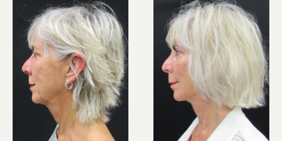 65-74 year old woman treated with Facelift, Facial Fat Transfer, Brow Lift, Eyelid Surgery - 71 y.o. female who received a facelift with fat grafting, upper and lower lid blepharoplasty and browlift.