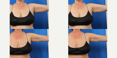 55-64 year old woman treated with Liposuction, Liposculpture, Thermage, Exilis - 55 year old female with liposuction and thermae on same day as surgery, followed by Exilis for additional skin tightening.