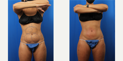 25-34 year old woman treated with Liposuction, Thermage, Exilis - 34 year old female with liposuction and thermae on same day as surgery, followed by Exilis for additional skin tightening.