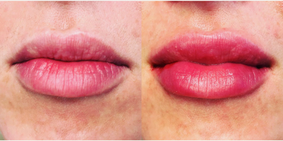 35-44 year old woman treated with Volbella - This 35 year old patient was looking for a fuller, natural lip enhancement. 1 syringe used.