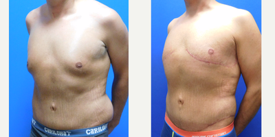 25-34 year old man treated with Male Breast Reduction - Massive weight loss patient desired chest contouring. Liposuction only was not an option due to loss of skin elasticity. He underwent direct excision,