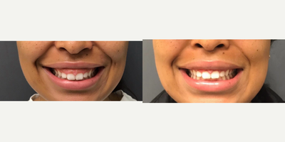 25-34 year old woman treated with Botox - Botox for gummy smile