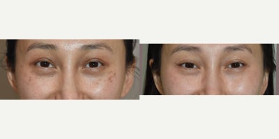 ABNOM birthmark removal with laser before and after photos. - Acquired bilateral nevus of Ota Macules, or ABNOM for short, is a rare type of birthmark that develops in adulthood. It is related to the traditional bluish Nevus of Ota Birthmarks that occur primarily in Asian patients and most commonly around the eyes.