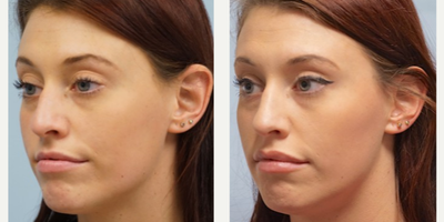 25-34 year old woman treated with Lip Augmentation - This young pretty female desires slightly more sculpted upper lip structure including the Cupid's bow or midline double convexity of the upper lip border. Juvederm is used to outline the border and enhance this crucial aesthetic elements the lip.