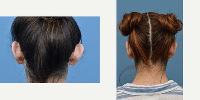 25-34 year old woman treated with Ear Surgery - This patient was concerned with the protrusion of her ears. An Otoplasty procedure was performed to address her concerns.
