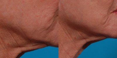 65-74 year old woman treated with Ellacor - 70 year old woman eager to treat her jawline and nasolabial folds after reading about the Ellacor Treatment. Dr. Olson recommended 2 treatments 60 days apart. She is so pleased with her Ellacor result she recently had a 3rd treatment to further tighten her jawline. Downtime was 5 days. This is her result 60 days after her second treatment.